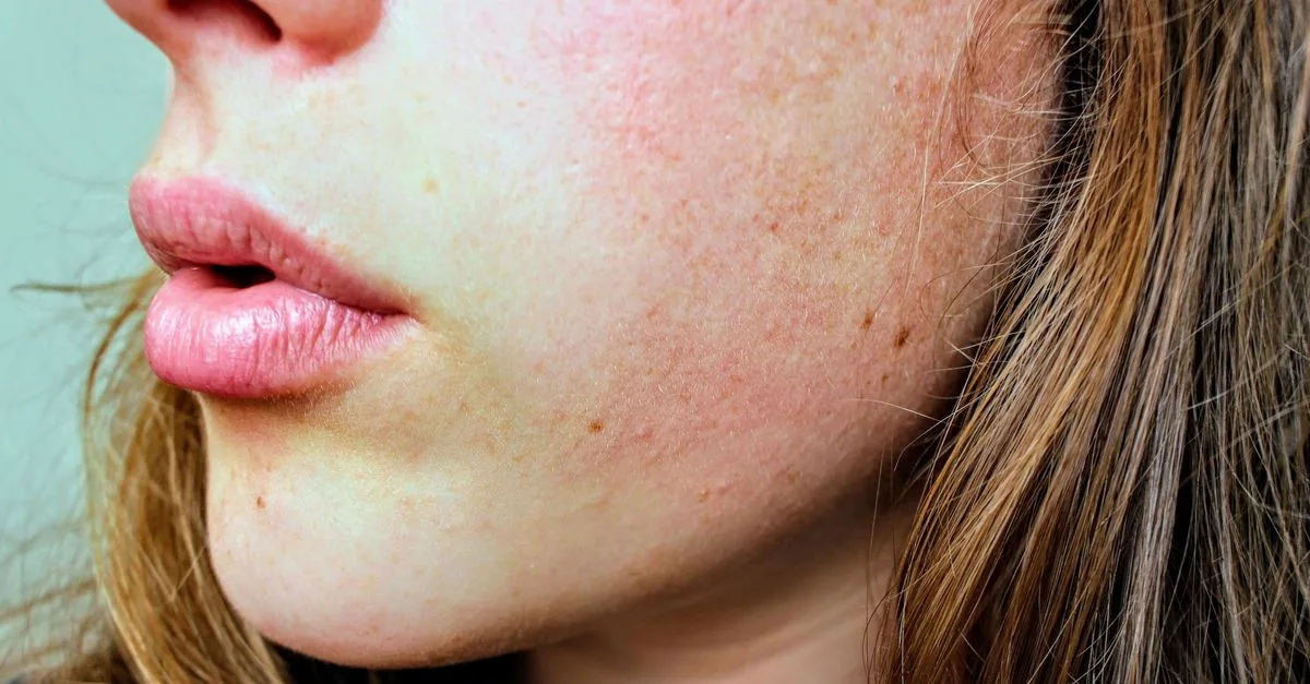 A close-up of a cheek with redness and visible texture