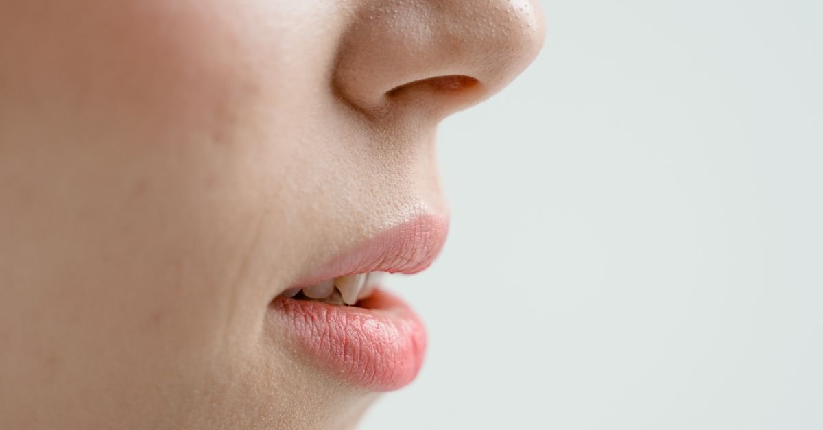 Blackheads and sebaceous filaments appear around the nose
