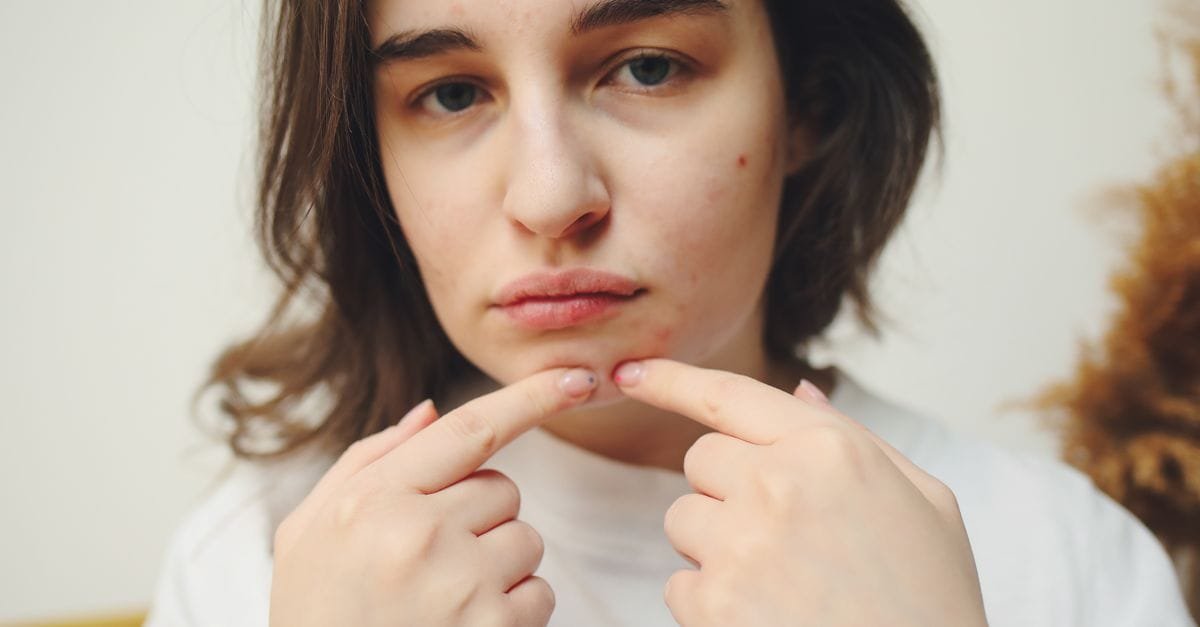 A woman about to squeeze a blemish on her chin